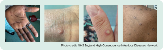 Visual examples of mpox rash. Photo credit: NHS England High Consequence Infectious Diseases Network.